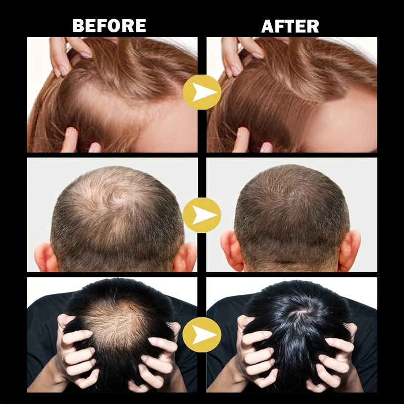 5% Minoxidil Hair Growth Solution – for Men’S Hair & Beard, Women’S Hair Loss Treatment, 1Oz Scalp Comfort Formula